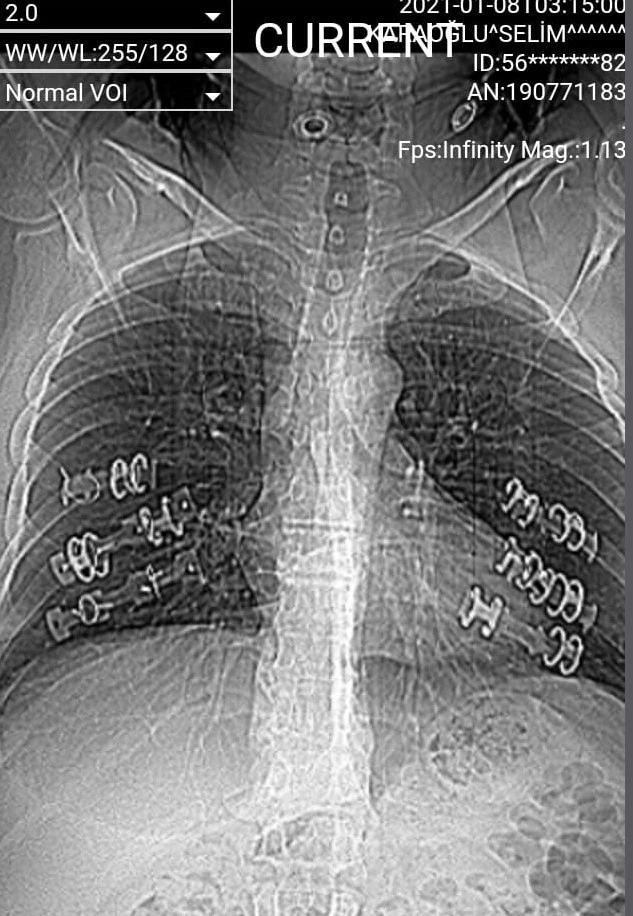Şiddetli öksürük hayatını mahvetti